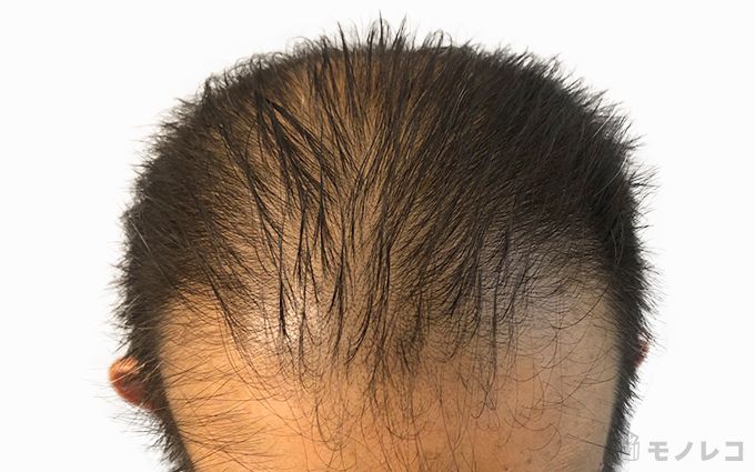 薄毛・抜け毛に悩む60代男性の頭皮の画像