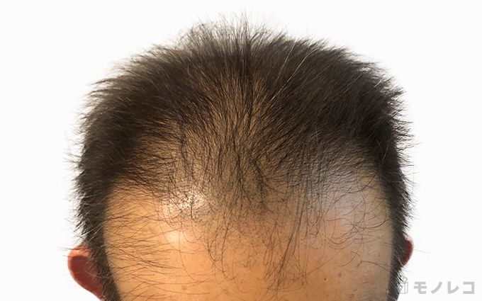 薄毛・抜け毛に悩む60代男性のシャンプー後の頭皮画像