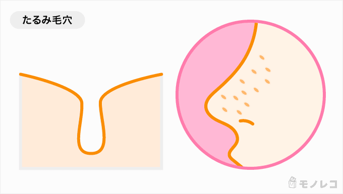 たるみ毛穴を説明するイラスト画像