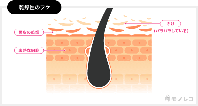 乾燥性のフケの特徴をイラストにした画像