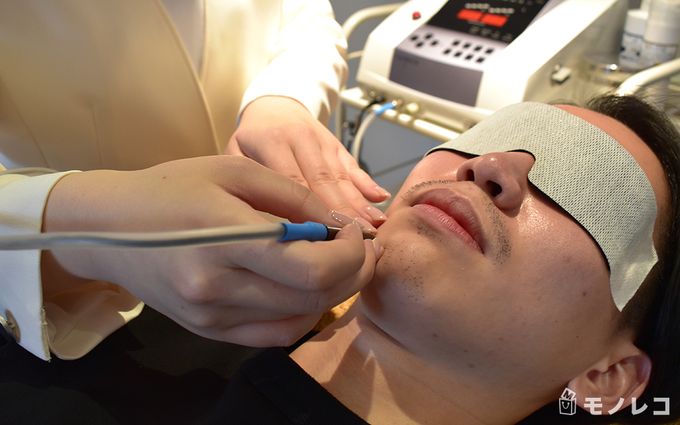 MEN'S TBCのヒゲ脱毛を施術している画像