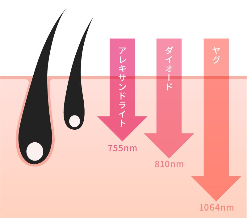 医療脱毛の機械の種類を解説 それぞれのレーザーの違いや向いている毛質は Lessmo レスモ By Ameba