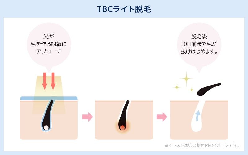 Tbcの顔脱毛っておすすめ コースの違いや料金 脱毛範囲を徹底解説 Lessmo レスモ By Ameba